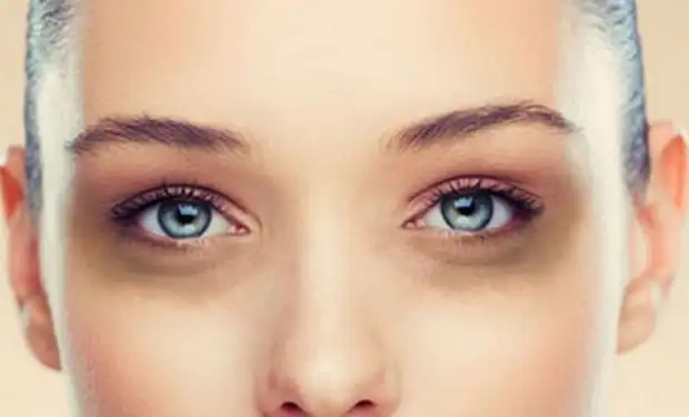Hvordan lage en effektiv og billig løsning for poser og blåmerker under øynene